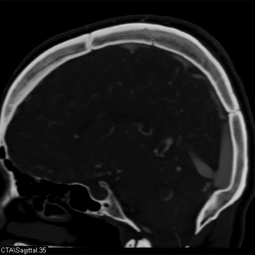 Cerebral arteriovenous malformation (Radiopaedia 28518-28759 D 32).jpg