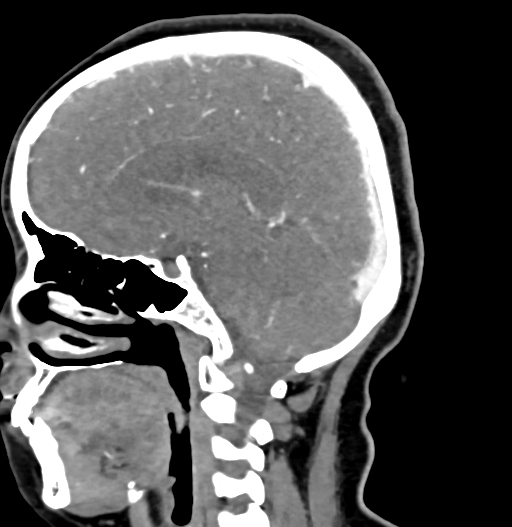 Cerebral arteriovenous malformation (Radiopaedia 73830-84645 D 43).jpg
