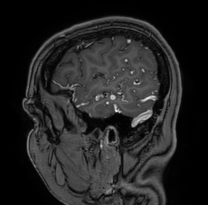 Cerebral arteriovenous malformation (Radiopaedia 74411-85654 Sagittal T1 C+ 15).jpg
