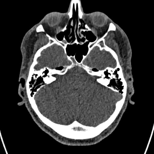 Cerebral arteriovenous malformation (Radiopaedia 78188-90746 Axial non-contrast 45).jpg