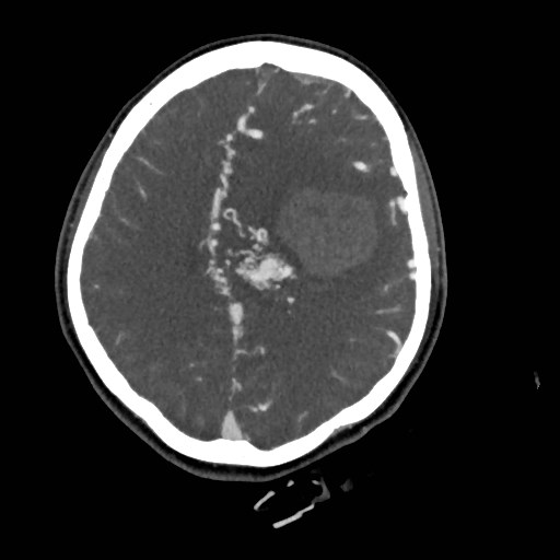 File:Cerebral arteriovenous malformation (Radiopaedia 79677-92888 A 37).jpg