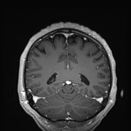 Cerebral arteriovenous malformation (Radiopaedia 84015-99245 Coronal T1 C+ 117).jpg