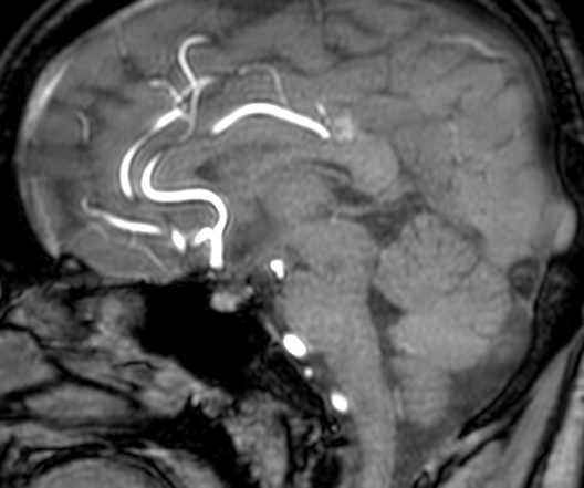 Cerebral arteriovenous malformation at posterior body of corpus callosum (Radiopaedia 74111-84925 J 200).jpg