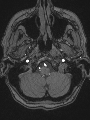 Cerebral arteriovenous malformation with hemorrhage (Radiopaedia 34422-35737 Axial MRA 9).png