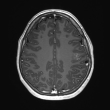 Cerebral cavernous venous malformation (Radiopaedia 70008-80021 Axial T1 C+ 63).jpg