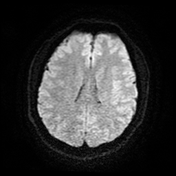 Cerebral cavernous venous malformation (Zabramski type II) (Radiopaedia 85511-101198 Axial DWI 20).jpg