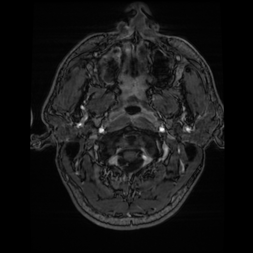 Cerebral cavernous venous malformation (Zabramski type II) (Radiopaedia 85511-101198 Axial T1 C+ fat sat 80).jpg