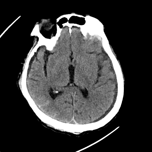File:Cerebral contusions, subarachnoid hemorrhage and subdural hygromas (Radiopaedia 55399-61830 Axial non-contrast 16).png