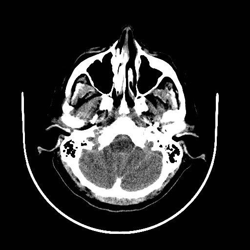 File:Cerebral edema (evolution in time) (Radiopaedia 19418-19439 non-contrast 15).jpg