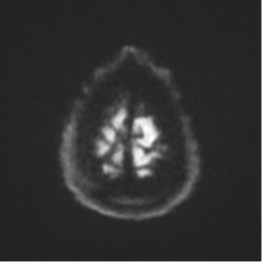 Cerebral embolic infarcts (embolic shower) (Radiopaedia 57395-64342 Axial DWI 70).png