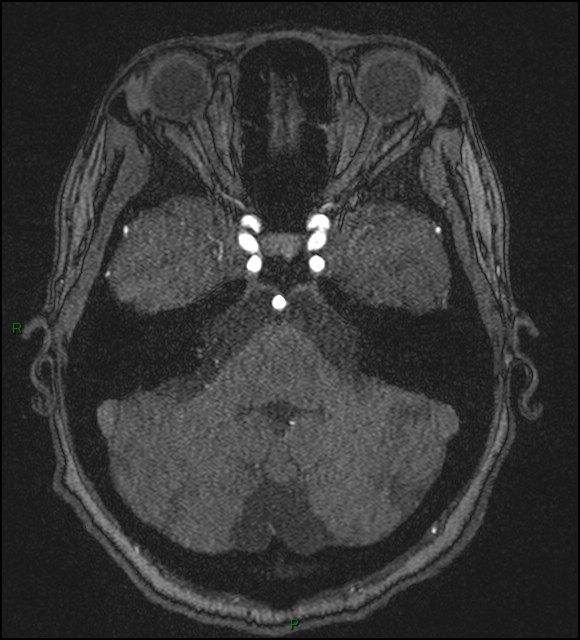 Cerebral fat embolism (Radiopaedia 35022-36525 Axial TOF 48).jpg