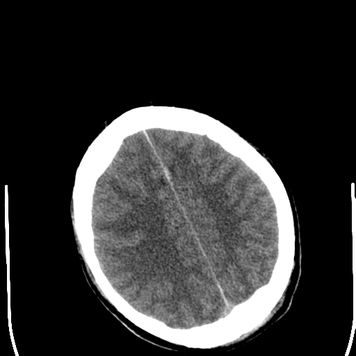 File:Cerebral hemorrhagic contusions- temporal evolution (Radiopaedia 40224-42752 Axial non-contrast 22).png