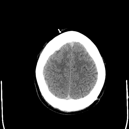File:Cerebral hemorrhagic contusions- temporal evolution (Radiopaedia 40224-42754 Axial non-contrast 25).png