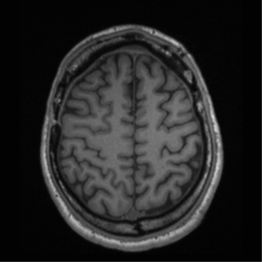 File:Cerebral hemorrhagic contusions- temporal evolution (Radiopaedia 40224-42757 Axial T1 61).png