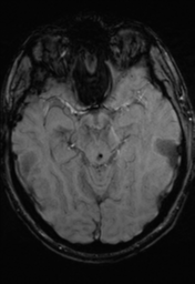 File:Cerebral hemorrhagic contusions- temporal evolution (Radiopaedia 40224-42757 D 15).png