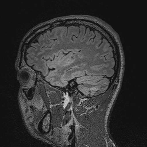 File:Cerebral hemorrhagic contusions- temporal evolution (Radiopaedia 40224-42757 Sagittal T1 23).png