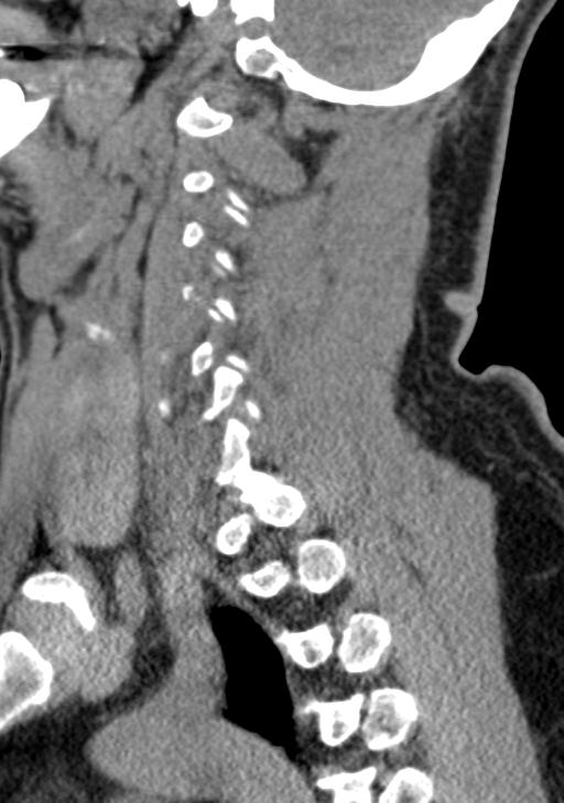 Cerebral hemorrhagic contusions and cervical spine fractures (Radiopaedia 32865-33841 G 40).jpg