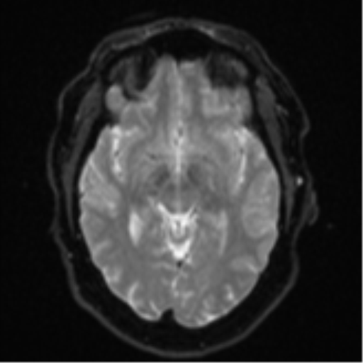 Cerebral metastases mimicking multifocal glioblastoma (Radiopaedia 50843-56353 Axial DWI 12).png