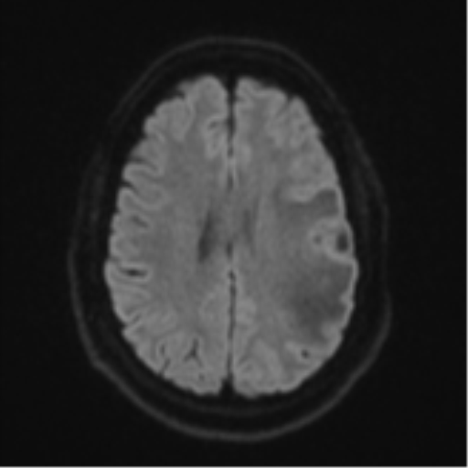 Cerebral metastases mimicking multifocal glioblastoma (Radiopaedia 50843-56353 Axial DWI 46).png
