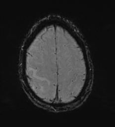 Cerebral metastasis - melanoma (Radiopaedia 54718-60954 Axial SWI 47).png