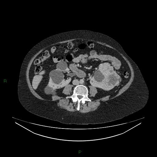 Cerebral metastasis from renal cell carcinoma (Radiopaedia 82306-96378 A 100).jpg