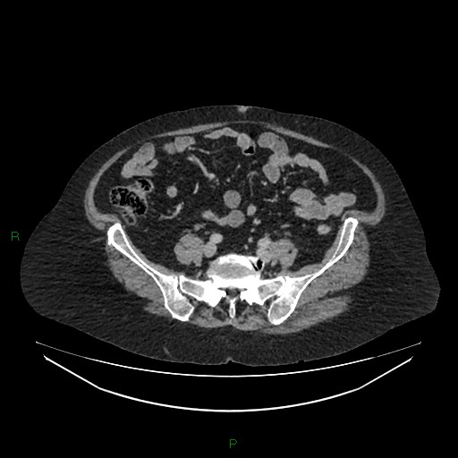 File:Cerebral metastasis from renal cell carcinoma (Radiopaedia 82306-96378 A 129).jpg