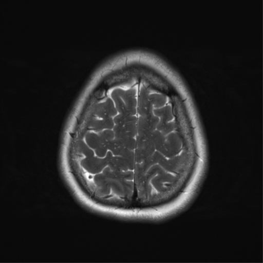 File:Cerebral metastasis mimicking glioblastoma (Radiopaedia 69155-78937 Axial T2 35).png
