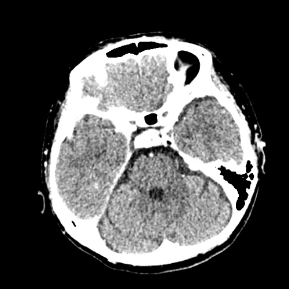 File:Cerebral ring enhancing lesions - cerebral metastases (Radiopaedia 44922-48818 B 95).jpg