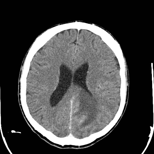 File:Cerebral toxoplasmosis (Radiopaedia 43956-47460 Axial C+ delayed 24).jpg