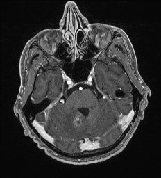 File:Cerebral toxoplasmosis (Radiopaedia 43956-47461 Axial T1 C+ 19).jpg