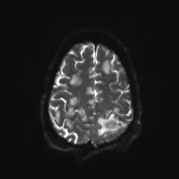 Cerebral toxoplasmosis (Radiopaedia 53993-60132 Axial DWI 22).jpg