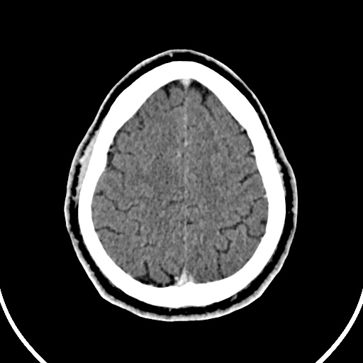 File:Cerebral venous angioma (Radiopaedia 69959-79977 B 85).jpg