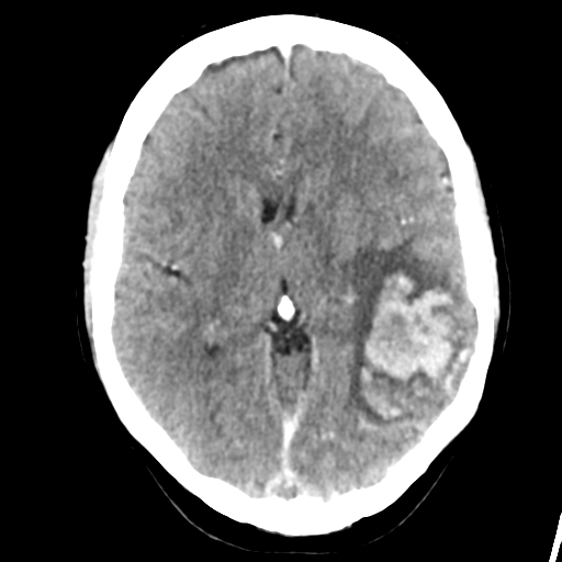 Cerebral venous hemorrhagic infarction (Radiopaedia 57576-64538 Axial C+ 23).png