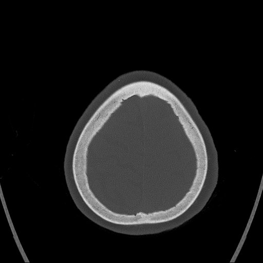 Cerebral venous infarction with hemorrhage (Radiopaedia 65343-74381 Axial bone window 169).jpg