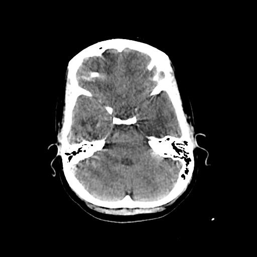 Cerebral venous throbmosis - hemorrhagic venous infarction (Radiopaedia 87318-103613 Axial non-contrast 45).jpg