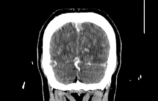 File:Cerebral venous thrombosis (CVT) (Radiopaedia 77524-89685 C 57).jpg