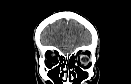 Cerebral venous thrombosis (CVT) (Radiopaedia 77524-89685 C 9).jpg