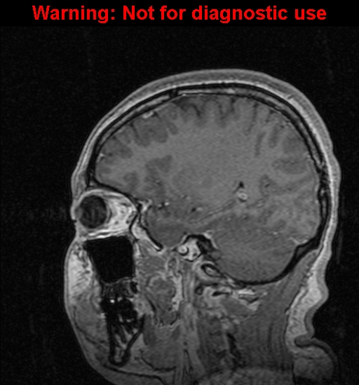 Cerebral venous thrombosis (Radiopaedia 37224-39208 Sagittal T1 C+ 103).jpg