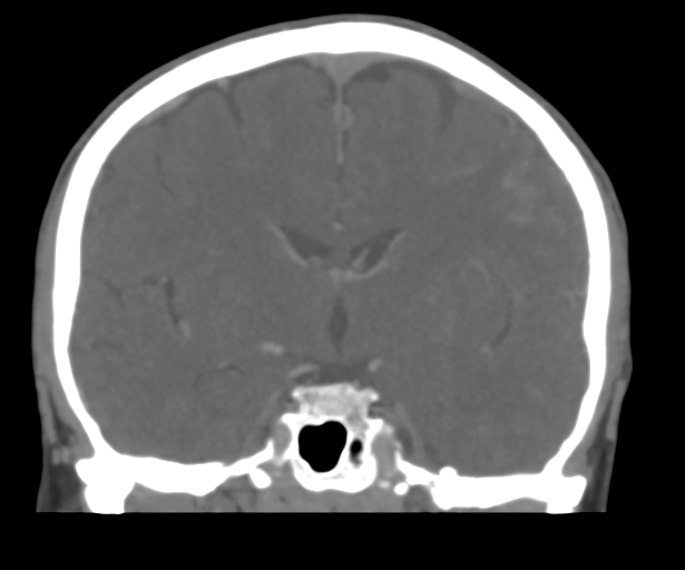 Cerebral venous thrombosis (Radiopaedia 38392-40467 Coronal CTA-Venogram 31).png