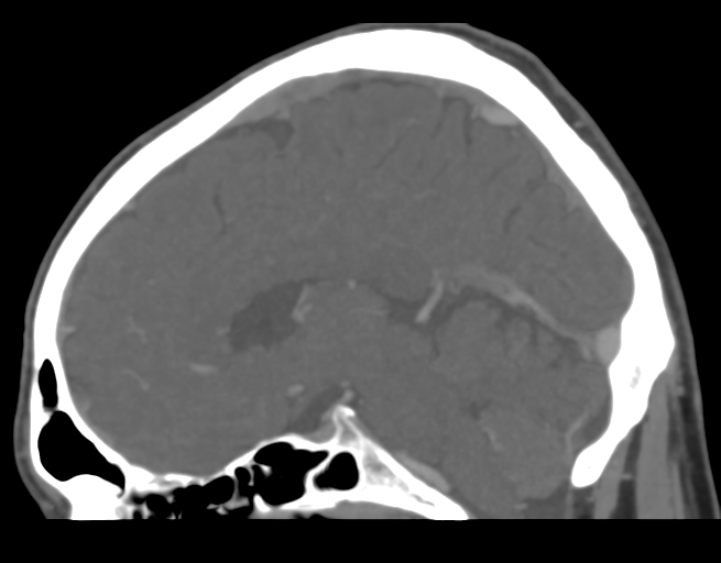 Cerebral venous thrombosis (Radiopaedia 38392-40467 D 25).png
