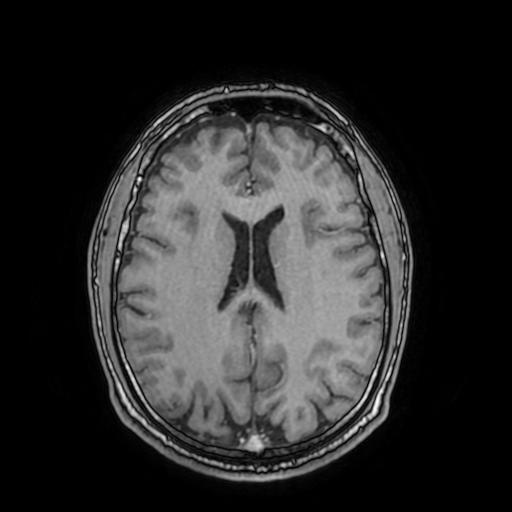 File:Cerebral venous thrombosis with secondary intracranial hypertension (Radiopaedia 89842-106957 Axial T1 C+ 112).jpg