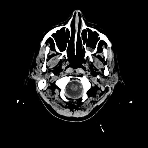 Cerebral venous thrombosis with venous hemorrhagic infarct (Radiopaedia 90354-107660 Axial non-contrast 4).jpg