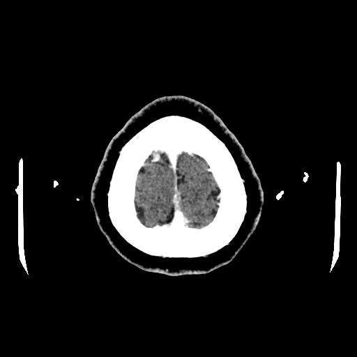 File:Cerebral venous thrombosis with venous hemorrhagic infarct (Radiopaedia 90354-107660 Axial with contrast 158).jpg