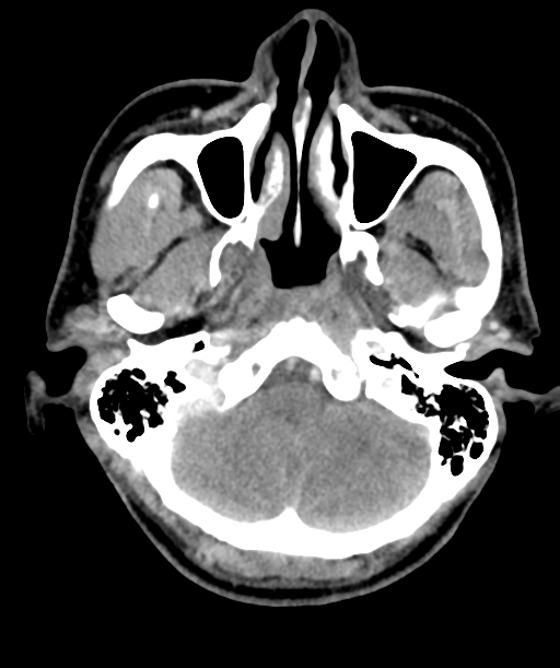 Cervical abscess (Radiopaedia 43725-47184 A 7).png