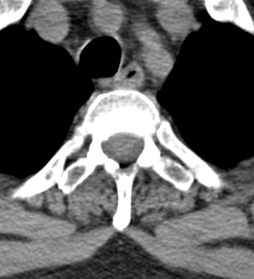 Cervical canal stenosis - OPLL and osteophytes (Radiopaedia 47329-51910 Axial non-contrast 64).png