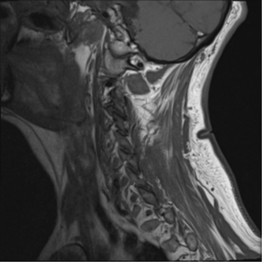 File:Cervical canal stenosis due to ossification of the posterior longitudinal ligament (Radiopaedia 47260-51824 Sagittal T1 1).png