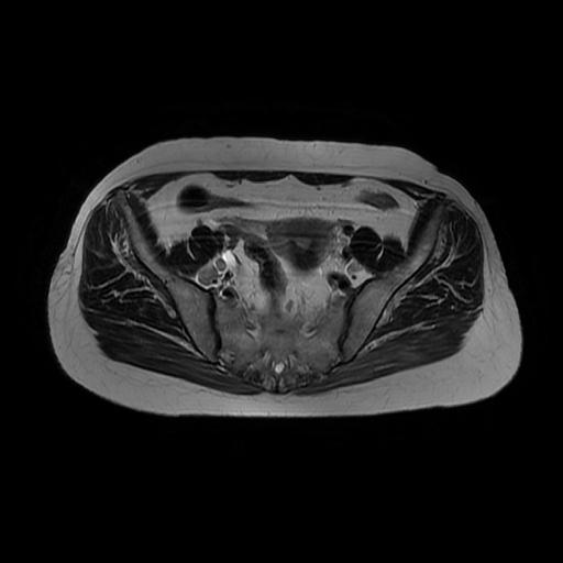 File:Cervical carcinoma (Radiopaedia 67644-77047 Axial T2 8).jpg