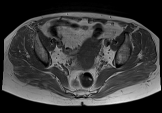 File:Cervical carcinoma (Radiopaedia 88312-104943 Axial T1 11).jpg
