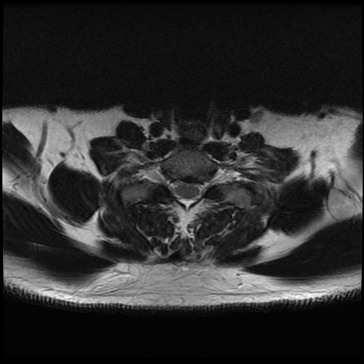File:Cervical disc extrusion (Radiopaedia 59074-66364 Axial T2 15).jpg