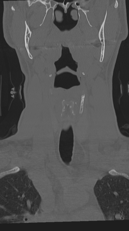 Cervical intercalary bone (Radiopaedia 35211-36748 Coronal bone window 17).png